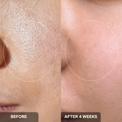 Close-up: smoother cheek after Bubble Mask Clay